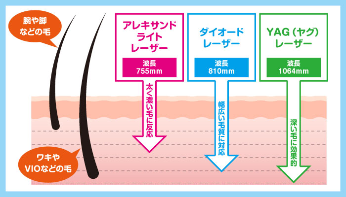 医療レーザーの種類